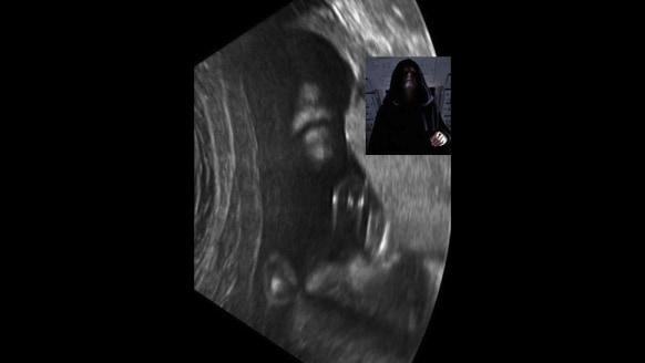 Palpatine in utero ?